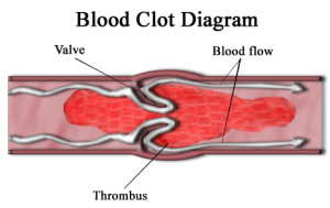 Formation of a Blood Clot