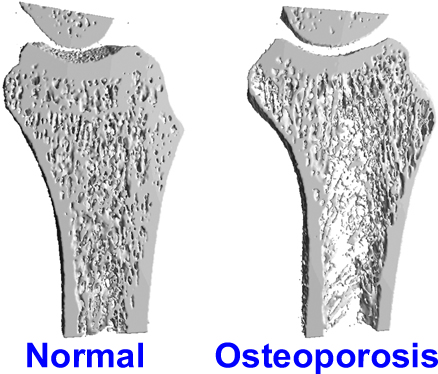 Tips to avoid osteoporosis